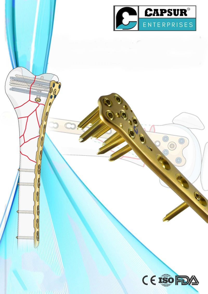 Large Fragment Locking Implants