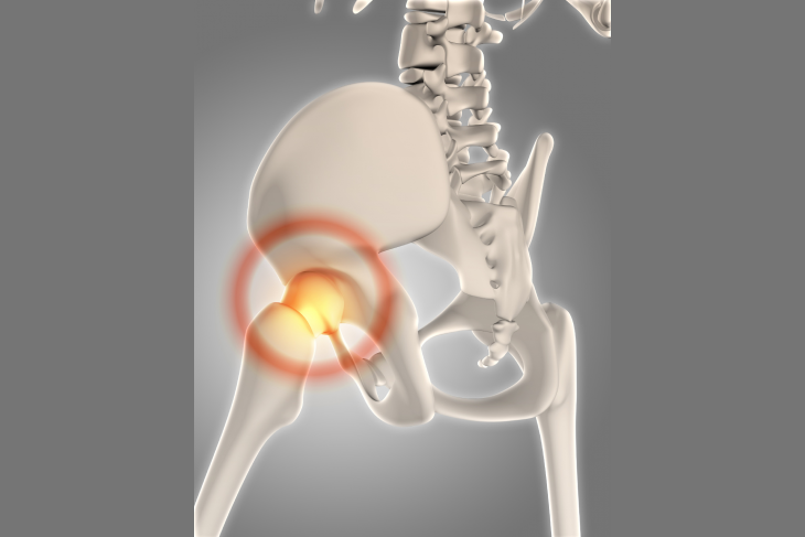 Orthopedic Implants